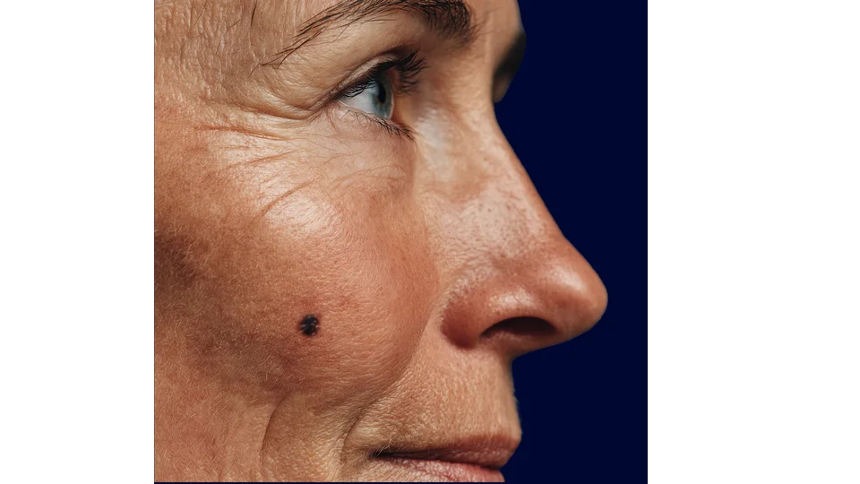 Rostro con una lesión pigmentada sobre piel fotoenvejecida